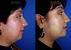 Neck Lift