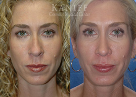 , Rhinoplasty Before and After Photos