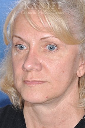 , Facelift
