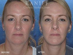 , Facelift