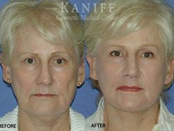 , Facelift