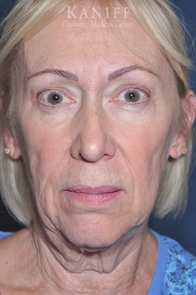 Facelift