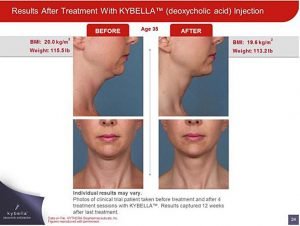 Kybella Sacramento Double Chin Treatment