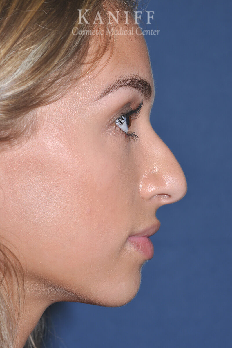 rhinoplasty