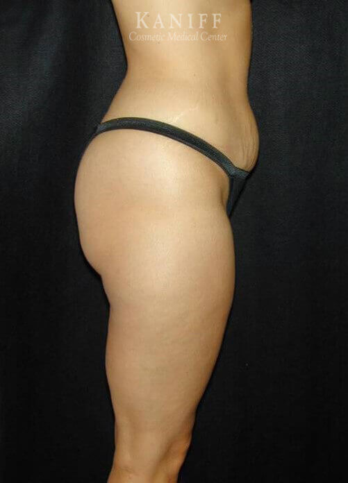 Liposuction