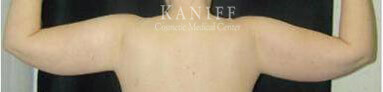 Liposuction