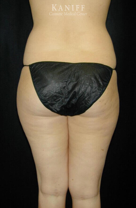 Liposuction