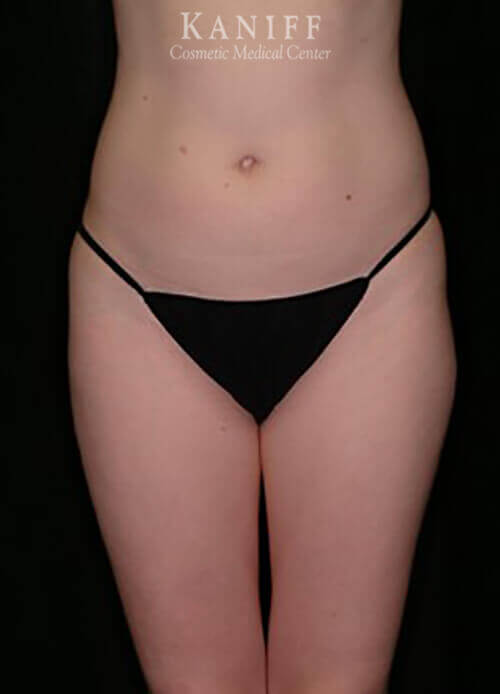 Liposuction
