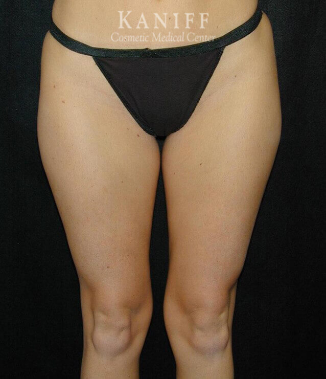 Liposuction