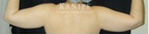 Liposuction
