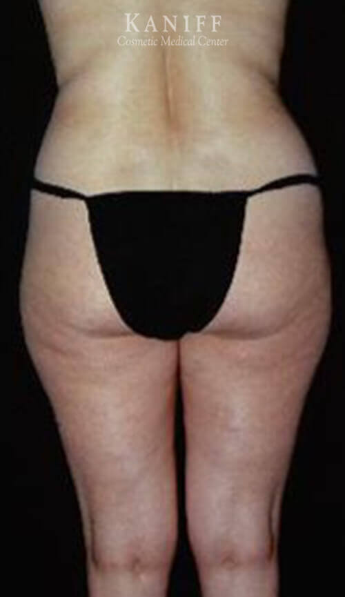 Liposuction