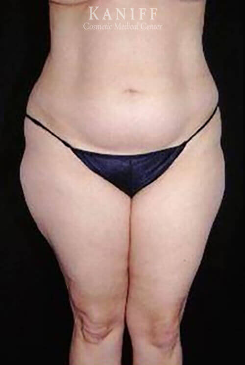 Liposuction