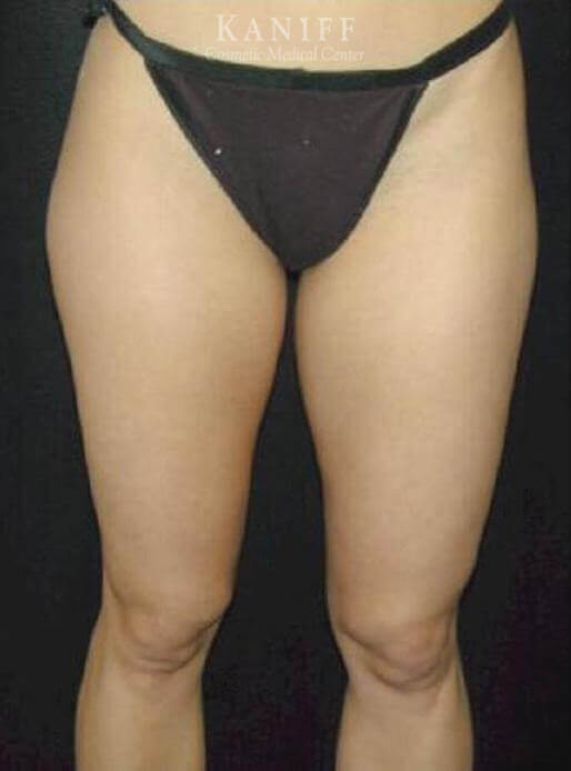 Liposuction