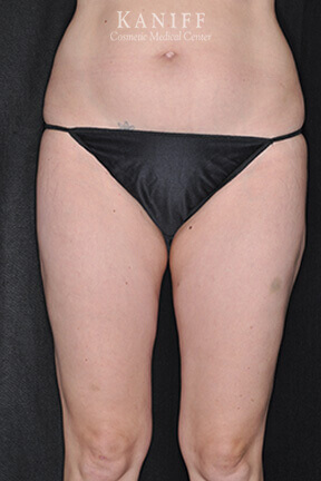 Liposuction