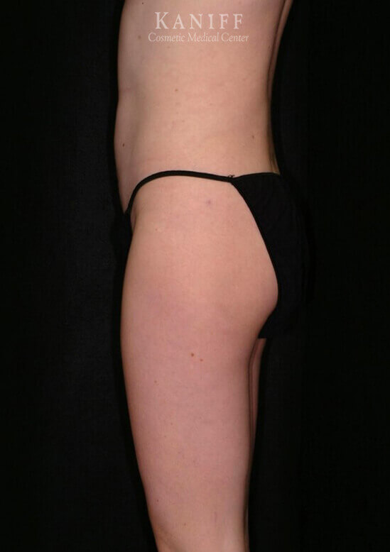 Liposuction