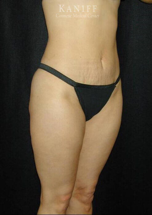 Liposuction