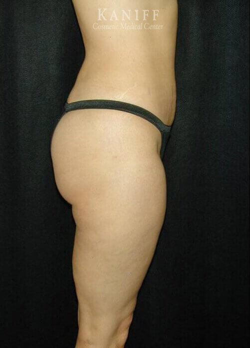 Liposuction