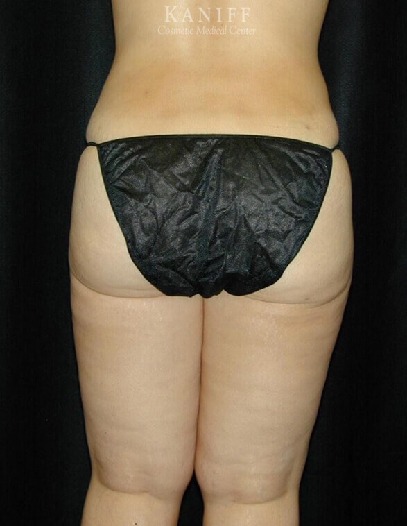 Liposuction