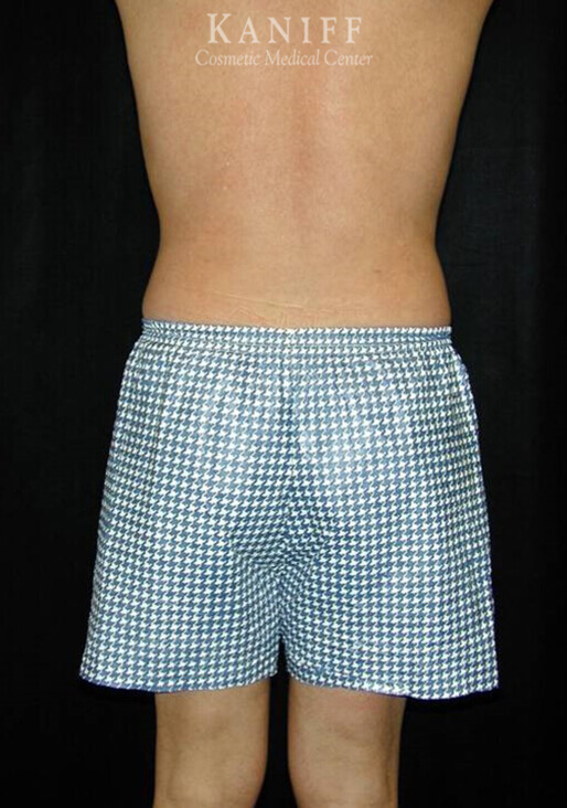 Liposuction