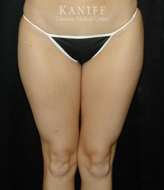 Liposuction