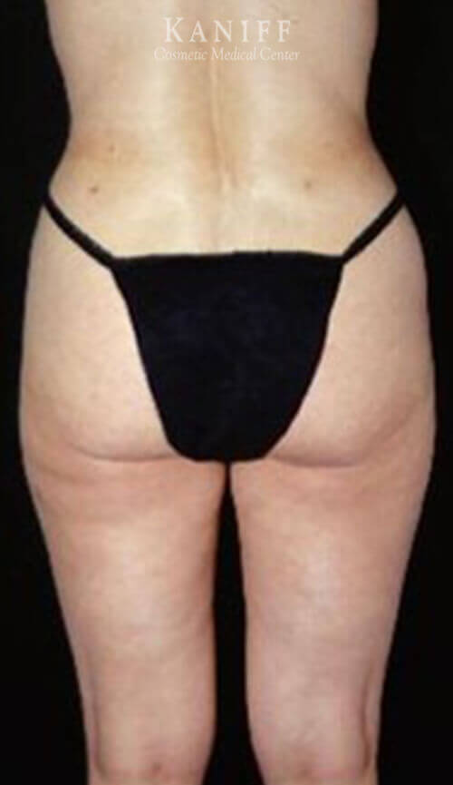 Liposuction