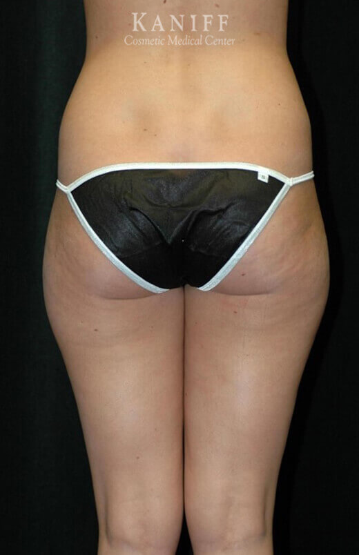 Liposuction