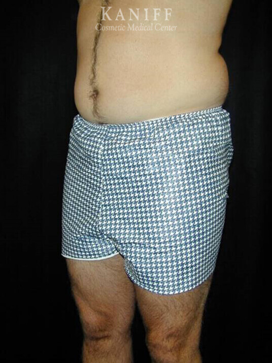 Liposuction