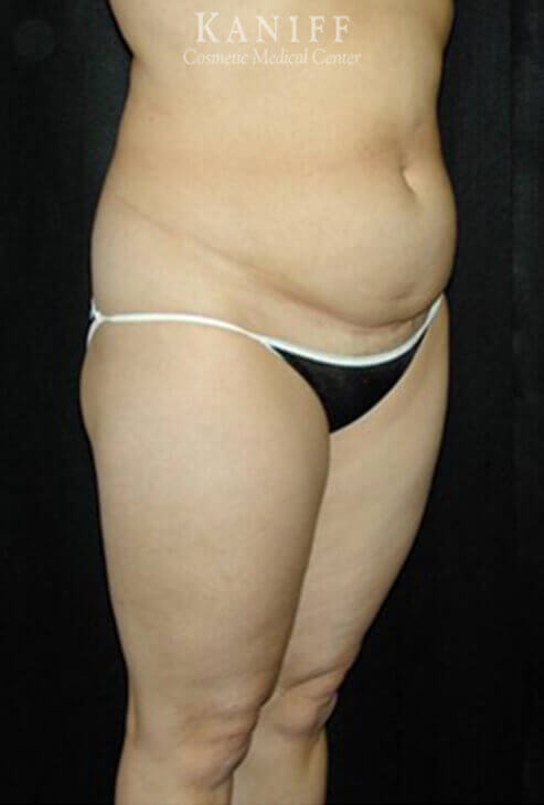 Liposuction