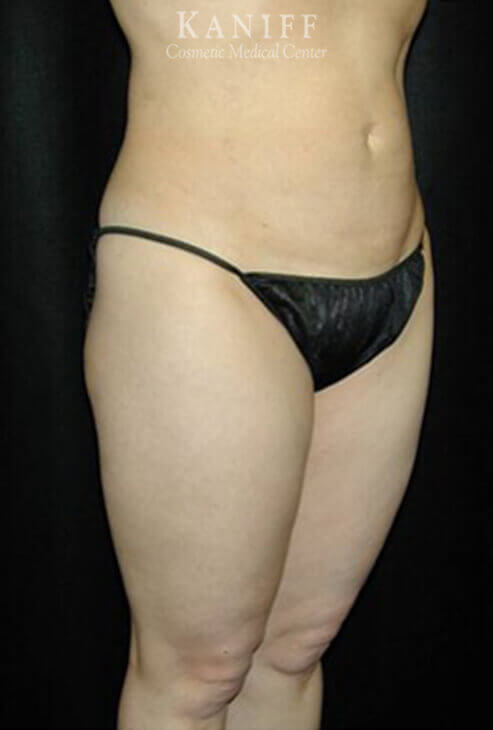 Liposuction