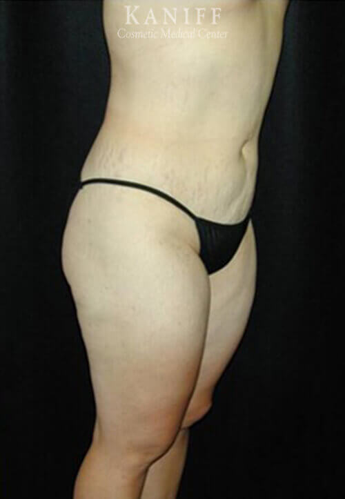 Liposuction