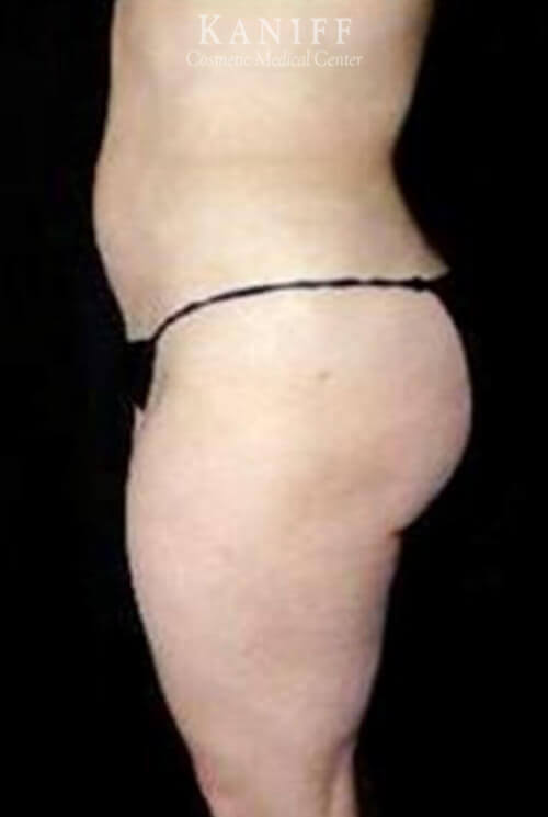 Liposuction