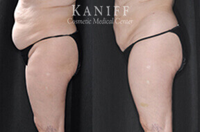 Liposuction