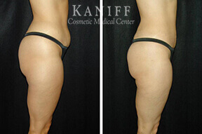 Liposuction