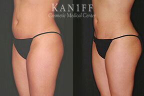 Liposuction
