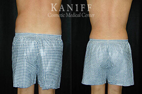 Liposuction