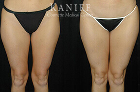 Liposuction