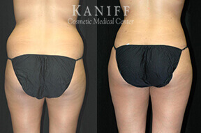 Liposuction