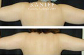 Liposuction