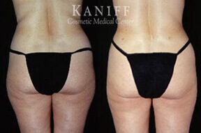 Liposuction