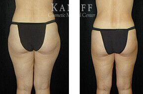 Liposuction