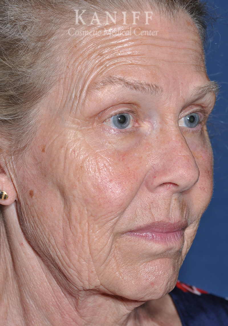 , Facelift