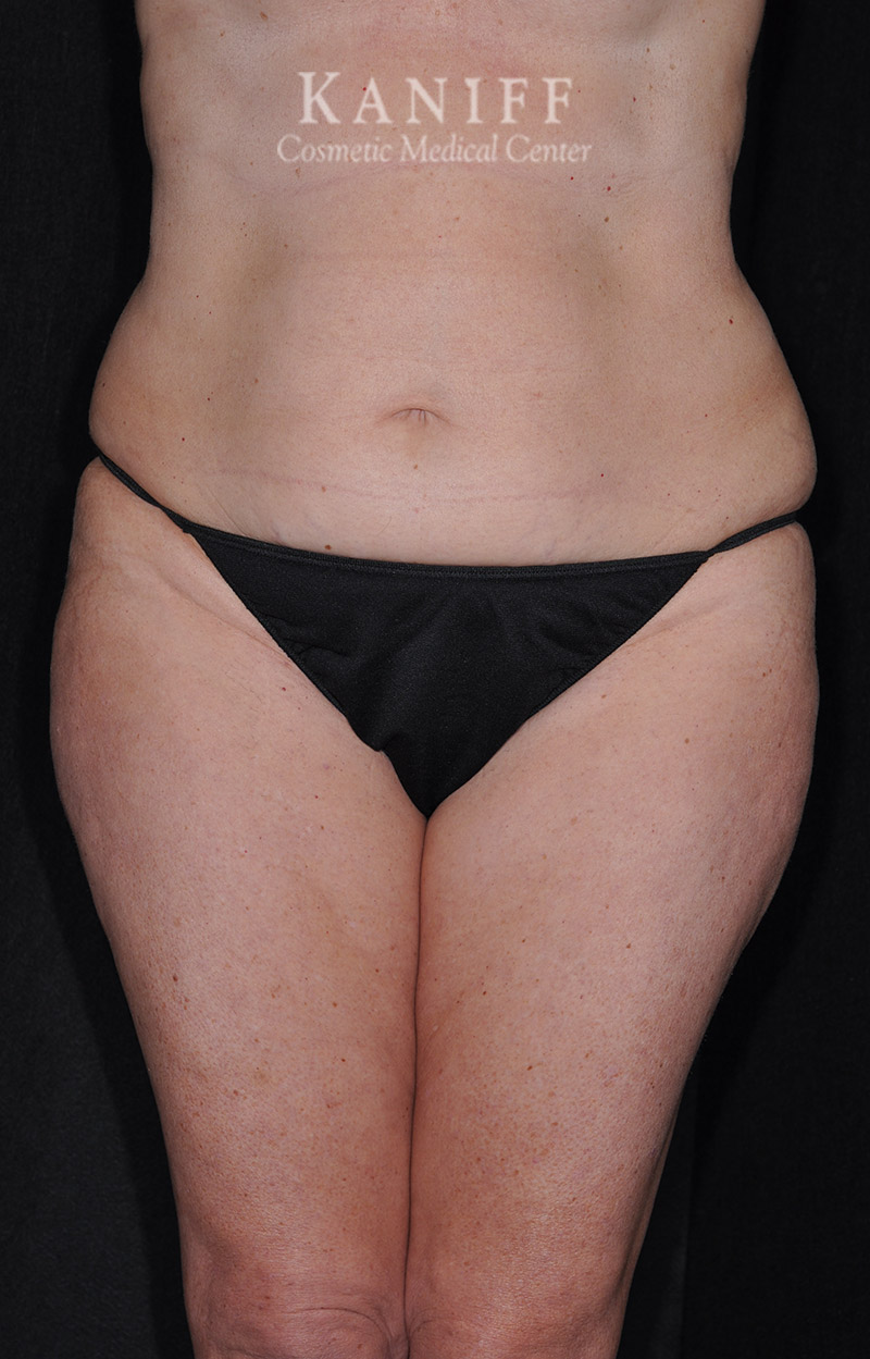 Liposuction