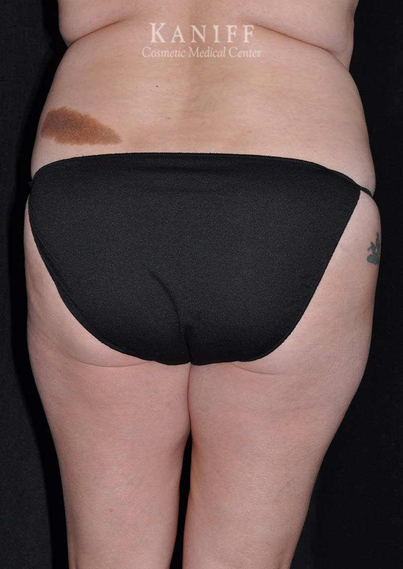 Liposuction