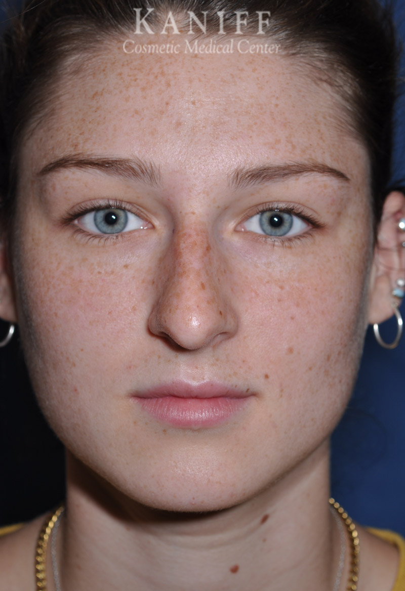 rhinoplasty
