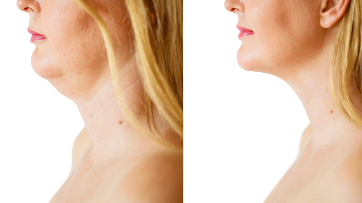 How Can You Get Rid Of A Double Chin Discover Kybella Kaniff
