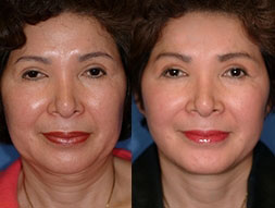 1117 Chin Implant and Facelift