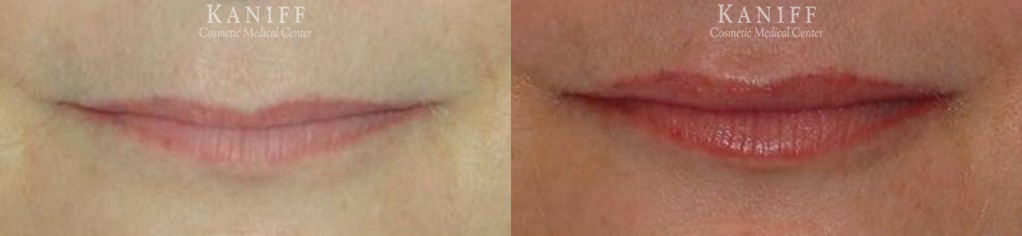 Lip Injections in Sacramento, CA | Kaniff Cosmetic Medical Center
