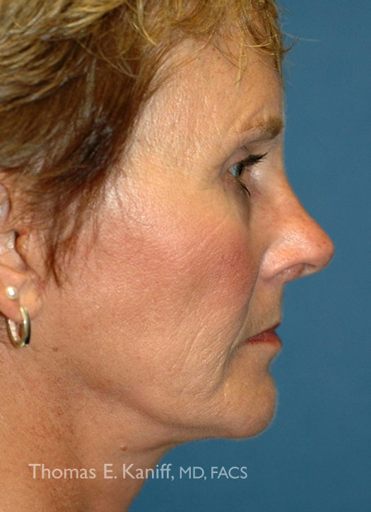 Patient 1108_Brow Lift_After_Side_525x7230-WM