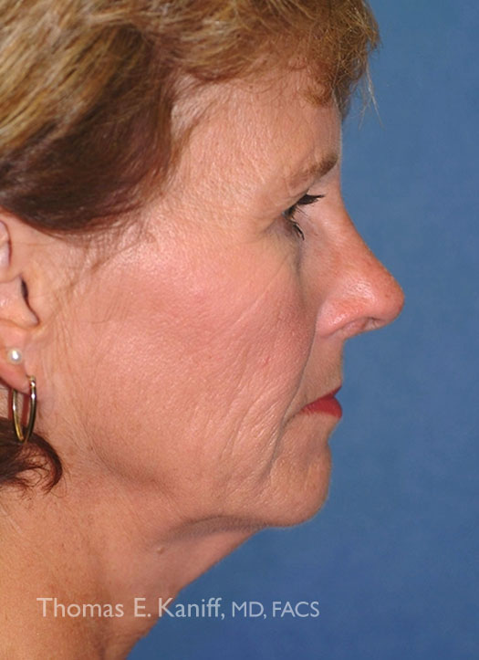 Patient 1108_Brow Lift_Before_side_525x723-WM