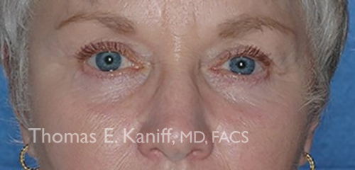 Patient 1122_front_after_eyelid - 500x240 - WM